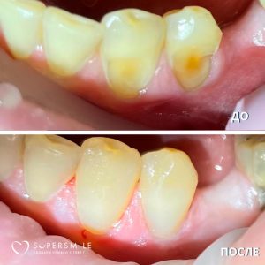 До/После №7890