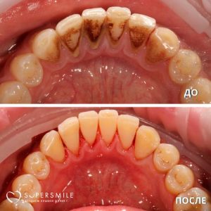 До/После №6512