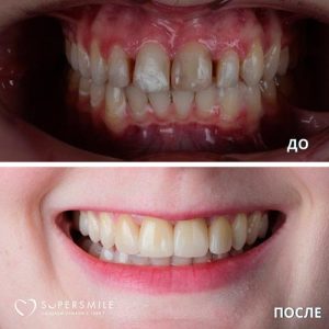 До/После №6793