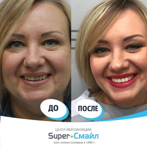 Имплантация/Протезирование (до/после)