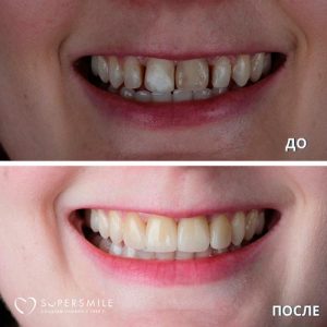 До/После №6792