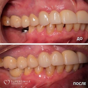 До/После №7466