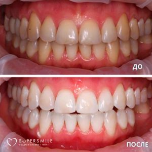 До/После №6510