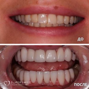 До/После №6790