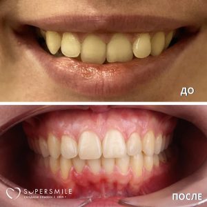 До/После №6581