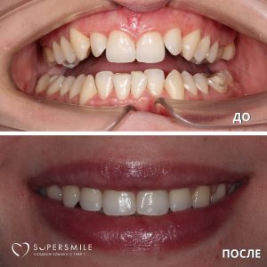 До/После №5278