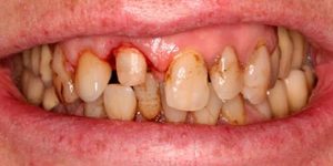 Шинирование при заболеваниях пародонта.