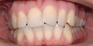 Скученное положение зубов