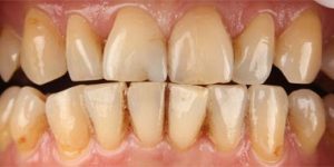 Пародонтоз