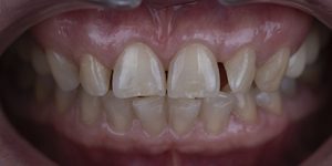 Небольшой разворот зуба.