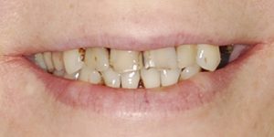 Пародонтоз