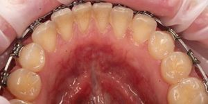 Гиперчувствительность эмали.