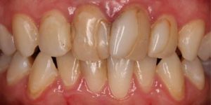 Микропротезирование.