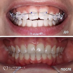 До/После №6585