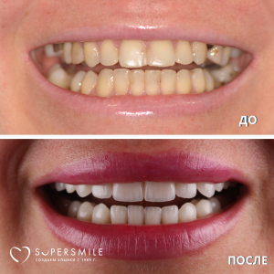 До/После №16183