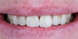 Восстановление зуба вкладкой или винирами.