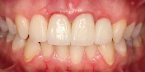 Восстановление зуба микропротезом.