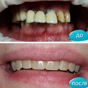 Имплантация All on 4 (до/после)