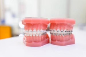 Ответы на часто задаваемые вопросы о брекетах. Часть 4