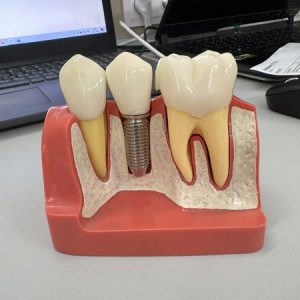 Из каких этапов состоит имплантация зубов?