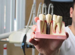 Шесть мифов об имплантации зубов