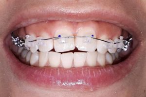 Разнообразие современных брекет-систем