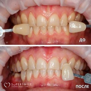 Отбеливание зубов Opalescence (до/после)