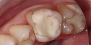 Старые пломбы.