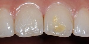 Кариес в стадии пятна.