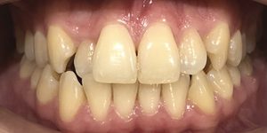 Неправильное расположение некоторых зубов или период после ортодонтического лечения.