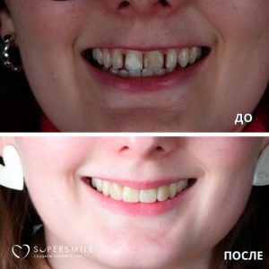 До/После №6805