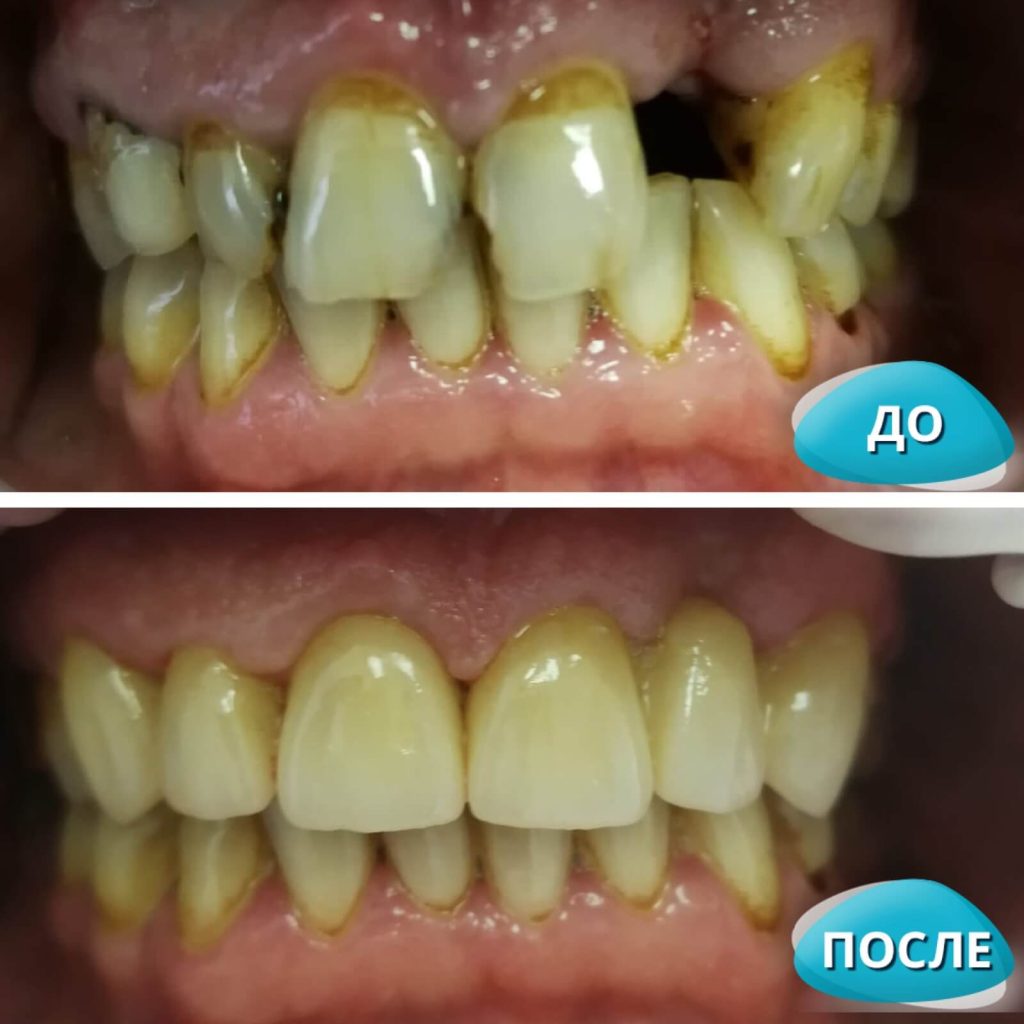 До/После №15652