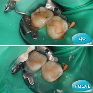 Лечение кариеса (до/после)