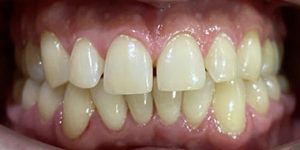 Диастемы или тремы