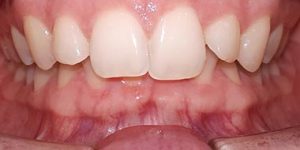 Исправление прикуса