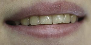 Внутриканальное отбеливание