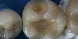 Осложнения кариеса в виде пульпита и периодонтита.