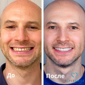 До/После №6804