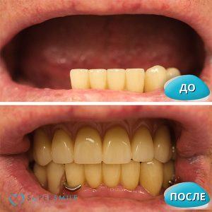 До/После №15374