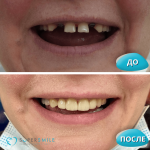 До/После №15376