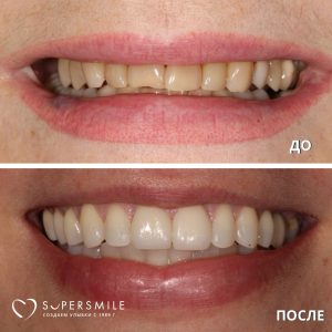 Тотальное протезирование