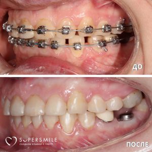 Исправление прикуса