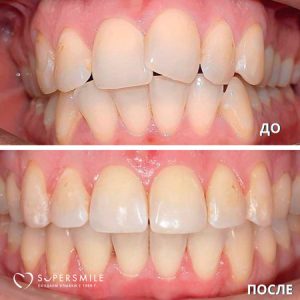 Этапы лечения с помощью брекетов