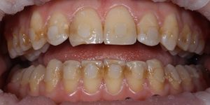 Патологическая стираемость.