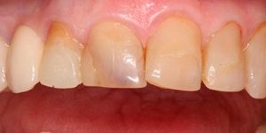 Коронки или мостовидные протезы.