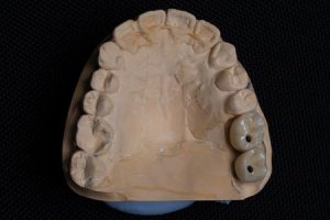 Исправляют ли элайнеры прикус?