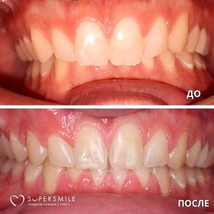 До/После №7348