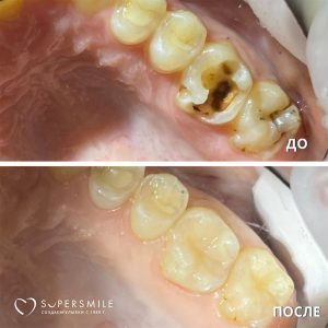 Лечение кариеса/ гигиена (до и после)