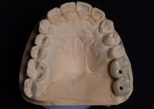 Протезирование зубов коронками