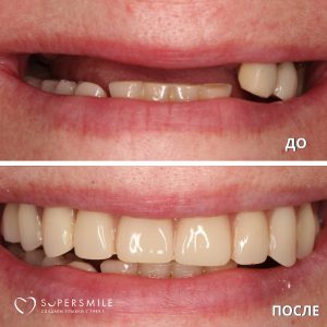 До/После №16192